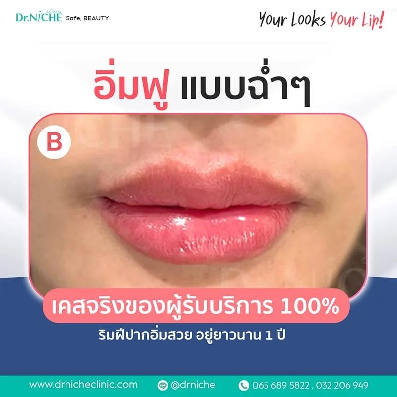 ทรงฟิลเลอร์ปาก แบบ Sexy อิ่มฟู