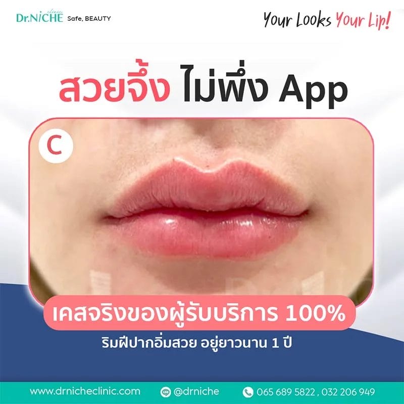ทรงฟิลเลอร์ปาก แบบ Cherry มีกระจับรับกับรูปปากล่าง
