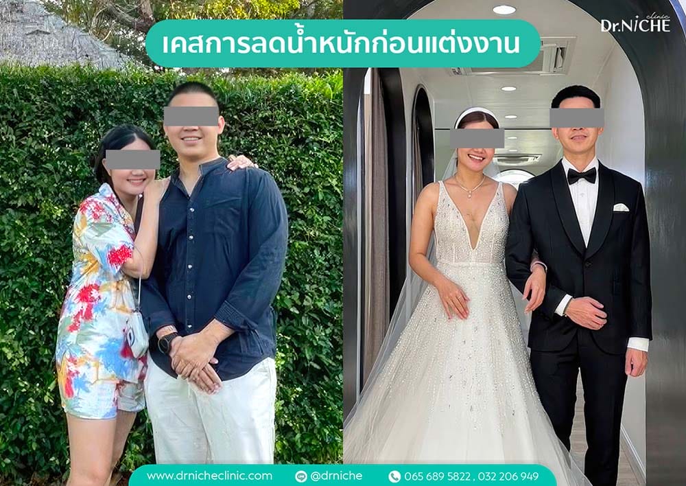 การลดน้ำหนักก่อนแต่งงาน
