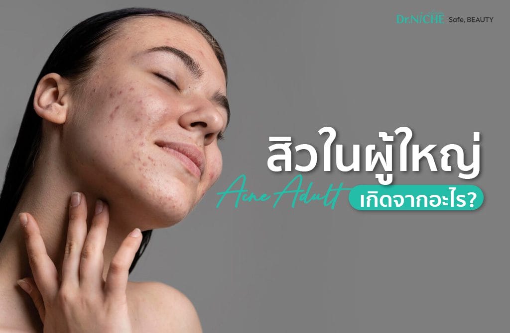 การรักษาสิวในผู้ใหญ่ อายุ 30-40 ทำไมยังเป็นสิว?