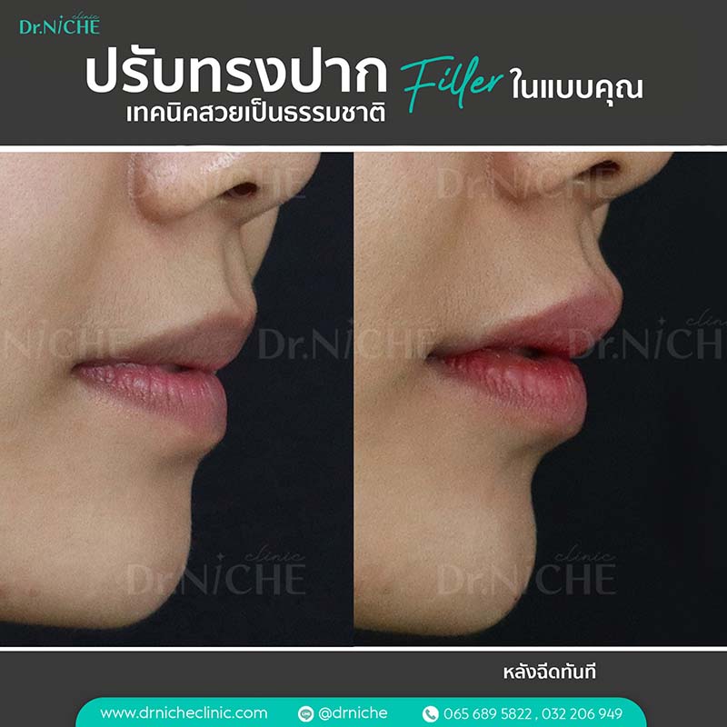 Lip Filler View 4