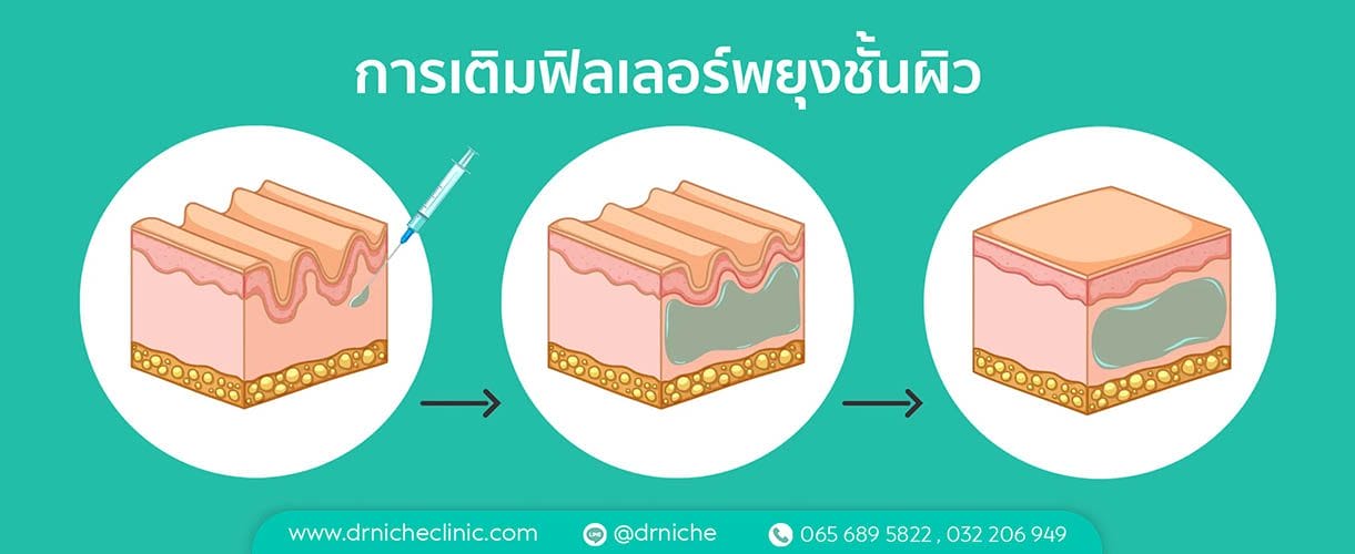 ภาพแสดงการเติมฟิลเลอร์เพื่อพยุงใต้ชั้นผิว