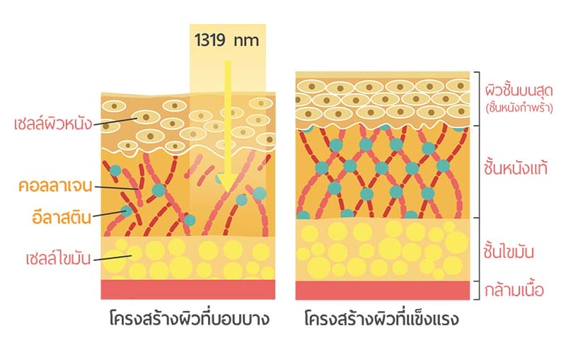 ADVA Light 1319 nm เลเซอร์รักษาสิว