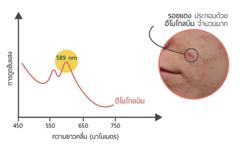 ADVA Light 589 nm เลเซอร์รักษาสิว