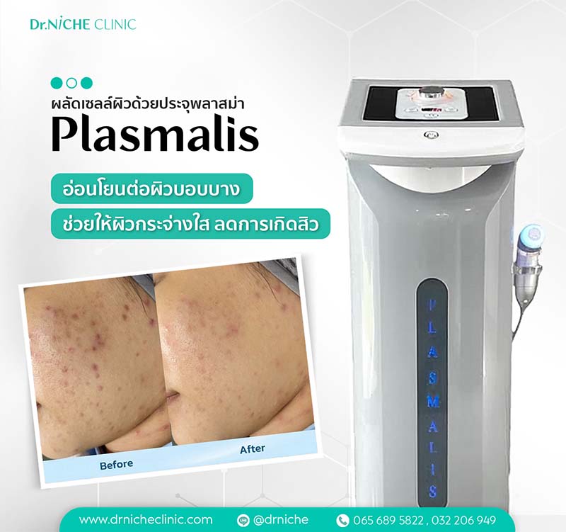 Plasmalis ผลัดเซลล์ผิวด้วยประจุพลาสม่า