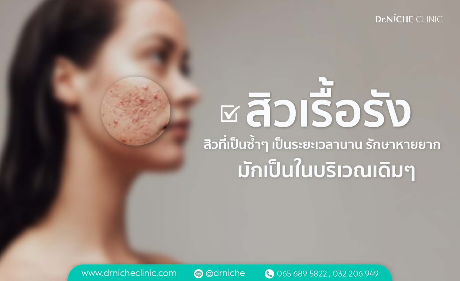 Chronic Acne สิวเรื้อรัง