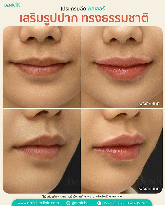 รีวิวฟิลเลอร์ปาก