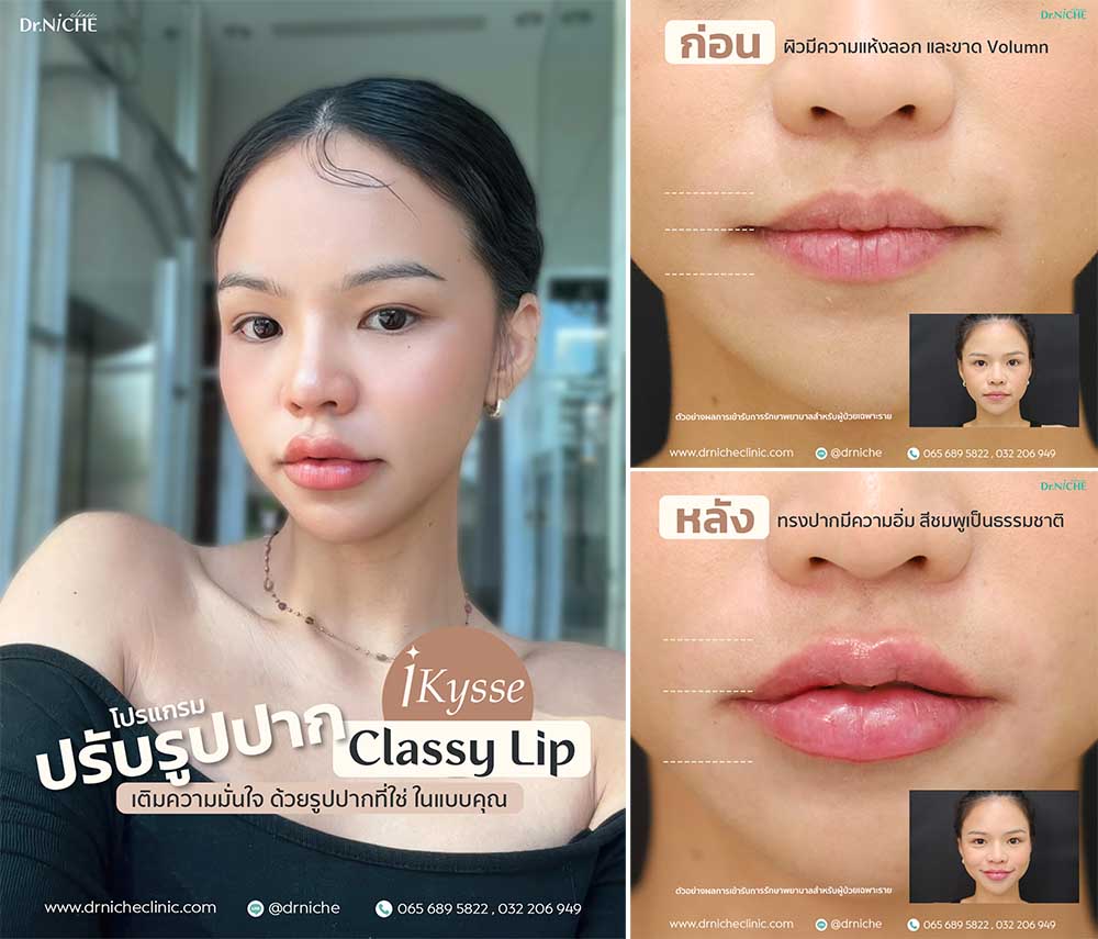 รีวิวฟิลเลอร์ปาก