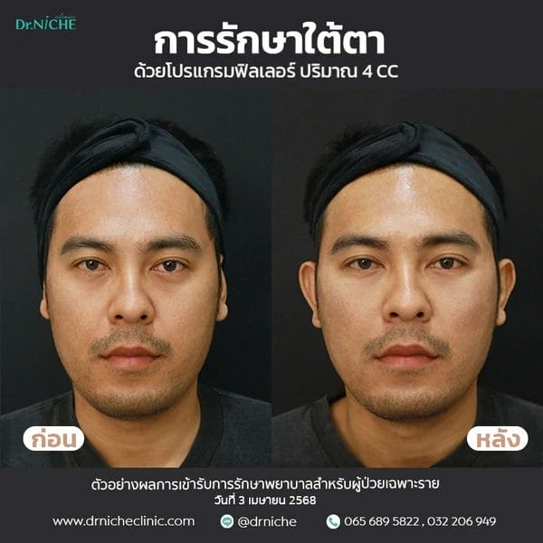 เคสการรักษา ฟิลเลอร์ใต้ตา