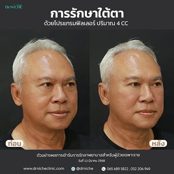 เคสการรักษา ฟิลเลอร์ใต้ตา