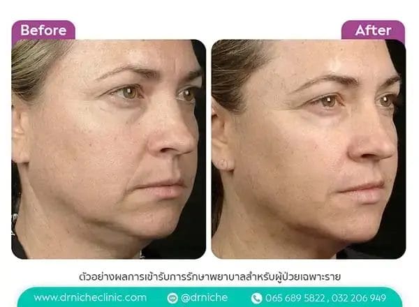 Thermage FLX Case 4