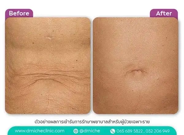 Thermage FLX Case6